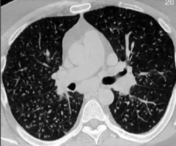 mrionline-imaging-mastery-series-micronodules-2021