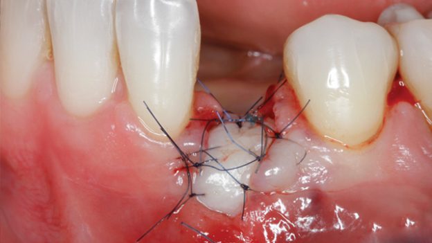 Gidedental Soft Tissue Management around Natural Teeth and Dental Implants 2020