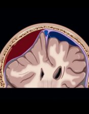 MRIOnline Emergency Series: Emergency Neuroimaging: Brain 2021 CME VIDEOS