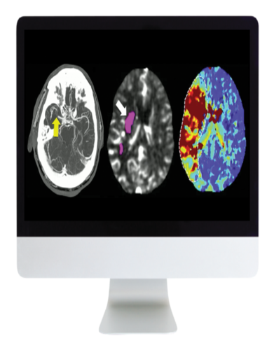 Code Stroke: What Every Radiologist Should Know 2022