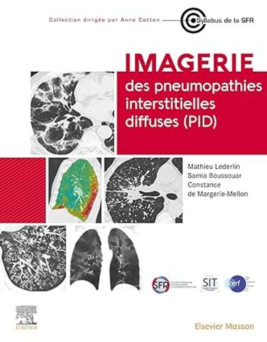 Imagerie des pneumopathies interstitielles diffuses (PID) (French Edition).2023 Original PDF