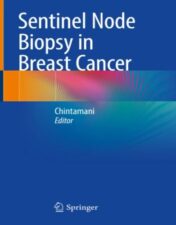 Sentinel Node Biopsy in Breast Cancer