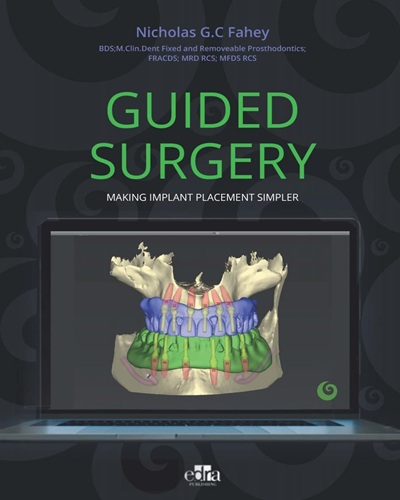 GUIDED SURGERY: Making implant placement simpler Kindle Edition